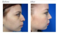 Rhinoplasty Los Angeles with Dr. Kenneth Hughes