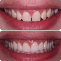 Cosmetic Veneers