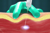 joint injections