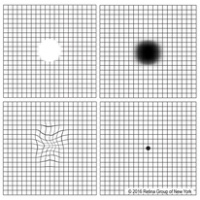 Macular problems like macular degeneration & diabetic retinopathy cause wavy, blurred or missing