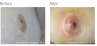 Inverted Nipple Correction with Dr. Kenneth Hughes