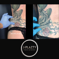 J-Plazty Skin Tightening Treatment