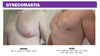 Before and After Gynecomastia Actual patient