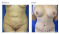 Tummy Tuck Los Angeles with Dr. Kenneth Hughes