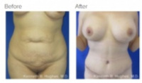Tummy Tuck Los Angeles with Dr. Kenneth Hughes