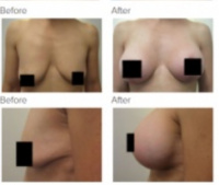 Breast Augmentation and Lift Los Angeles with Dr. Kenneth Hughes