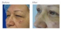 Eyelid Surgery Los Angeles with Dr. Kenneth Hughes