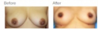 Breast Augmentation and Fat Grafting Los Angeles with Dr. Kenneth Hughes