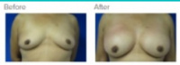 Breast Reconstruction and Breast Deformity Correction with Dr. Kenneth Hughes