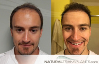 Hair Transplant Result