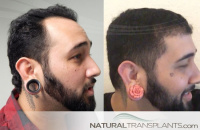 Hair Restoration