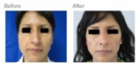 Rhinoplasty Los Angeles with Dr. Kenneth Hughes