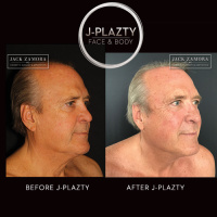 J-Plazty Face by Dr. Jack Zamora