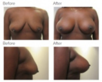 Breast Augmentation and Lift Los Angeles with Dr. Kenneth Hughes