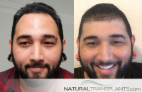 hair loss cure