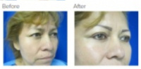 Eyelid Surgery Los Angeles with Dr. Kenneth Hughes