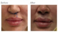 Lip Lift Los Angeles with Dr. Kenneth Hughes