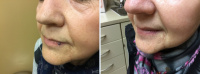 Venous Lake- before and after laser treatment