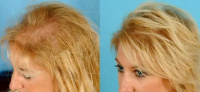 Hair Restoration