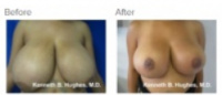 Breast lift Los Angeles with Dr. Kenneth Hughes