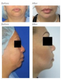 Chin Implant Los Angeles with Dr. Kenneth Hughes