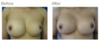 Breast Augmentation Revision Los Angeles with Dr. Kenneth Hughes