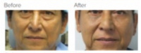 Facial Grafting Los Angeles with Dr. Kenneth Hughes