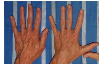 Hand treatments include: large vein removal, dermal fillers, age spot therapy