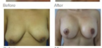 Breast Augmentation and Lift Los Angeles with Dr. Kenneth Hughes