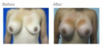 Breast Augmentation Revision Los Angeles with Dr. Kenneth Hughes