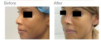 Rhinoplasty Los Angeles with Dr. Kenneth Hughes