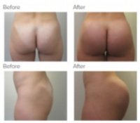 Butt Implants with Dr. Kenneth Hughes