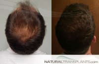 Hair Transplantation