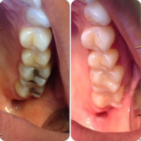 Cosmetic White Fillings