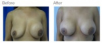 Breast Augmentation Revision Los Angeles with Dr. Kenneth Hughes