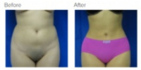 Liposuction with Dr. Kenneth Hughes