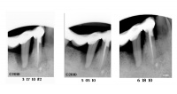 periodontium regeneration