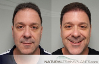Hair Transplant Surgery
