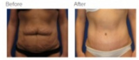 Tummy Tuck Los Angeles with Dr. Kenneth Hughes