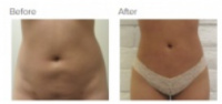 Liposuction Revision & Cellulite Reduction Los Angeles with Dr. Kenneth Hughes