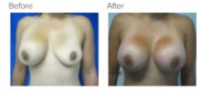 Breast Augmentation (Implants) Los Angeles with Dr. Kenneth Hughes
