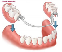 Partial Dentures San Jose Dentist