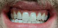 Glo Whitening After