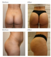 Liposuction with Dr. Kenneth Hughes
