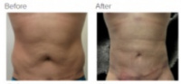 Liposuction Revision & Cellulite Reduction Los Angeles with Dr. Kenneth Hughes