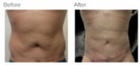 Liposuction Revision & Cellulite Reduction Los Angeles with Dr. Kenneth Hughes