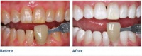 Whitening with KoR in-office bleaching