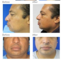 Chin Implant Los Angeles with Dr. Kenneth Hughes
