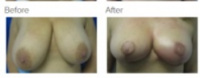 Breast Reduction Los Angeles with Dr. Kenneth Hughes