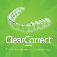 Clear Aligners